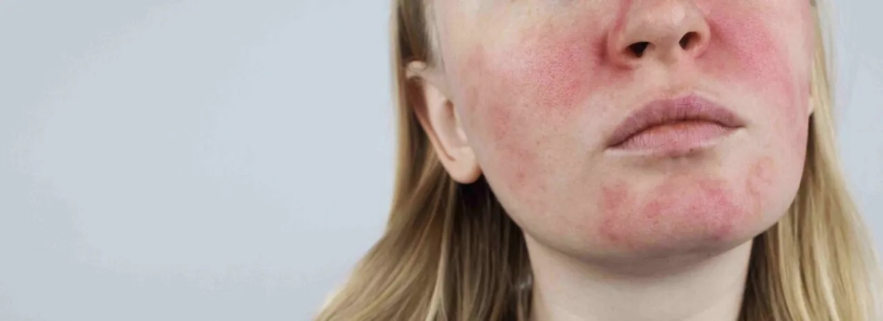 Jak zaradzić problemowi z Trądzikiem różowatym za pomocą Totalnej Biologii